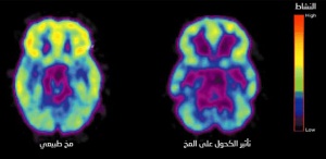 يقل نشاط المخ عند تناول الكحوليات (يمين الصورة)